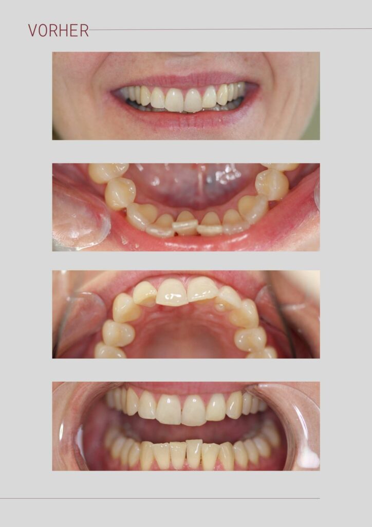 invisalign vorher